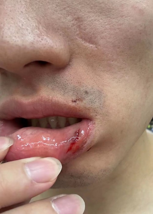 ?齐麟在社交媒体晒出于德豪嘴唇受伤的照片 看起来有点严重